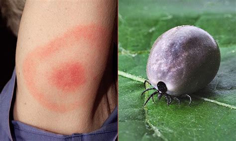 woman catches lyme disease from tick bite at clissold park say residents hackney citizen