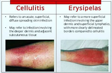 Cellulitis Vs Erysipelas Medizzy