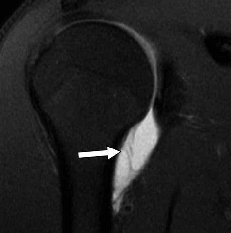 Mr Arthrogram Features That Can Be Used To Distinguish Between True