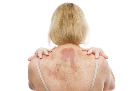 A Bruise On The Back A Woman With Extensive Hematoma After A Massage