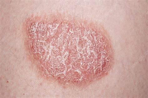 Plaque Psoriasis On The Skin Stock Image C0117475 Science Photo