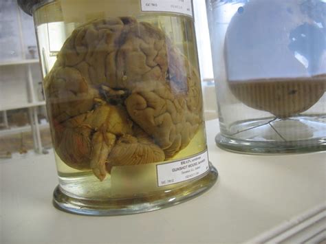 Brain In A Jar Went To The Surgeons Hall Museum Today