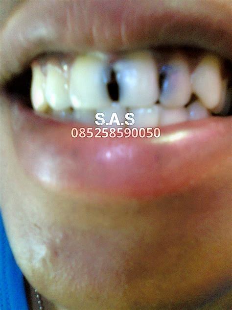 Penyebab utama ialah plak yang merupakan kumpulan dari. Cara Juga Seni S.A.S Menambal Gigi Depan Berlubang (Kropos ...