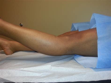 ACL Tear Knee Sports Orthobullets 10296 Hot Sex Picture