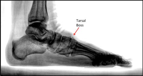 As an amazon associate we can earn a small commission from qualifying purchases. Tarsal Boss - FootEducation
