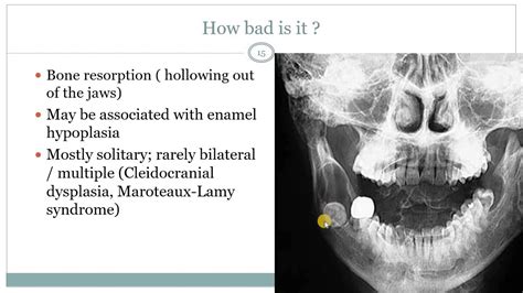 Dentigerous Cyst And Eruption Cyst Youtube