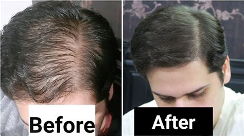 Rosemary Oil For Hair Growth Before And After Does It Really Work