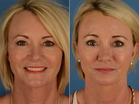 The Uplift Lower Face And Neck Lift Photos Naples Fl Patient 15169