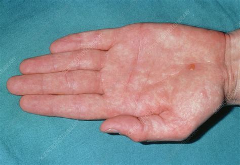 Mild Form Of Pompholyx Eczema Over The Palm Stock Image M1500078