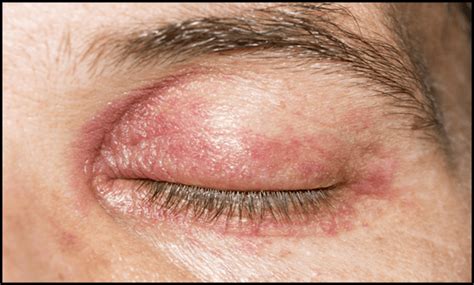 7 Causes And Effective Home Remedies To Get Rid Of Eyelid Rashes 2023