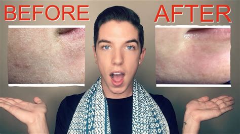 How To Fix Your Dry Flaky Skin Youtube