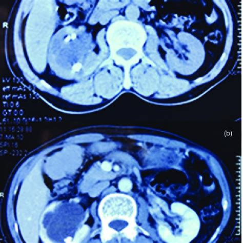 Nonenhanced Computed Tomography Ct A And Enhanced Ct B Scans