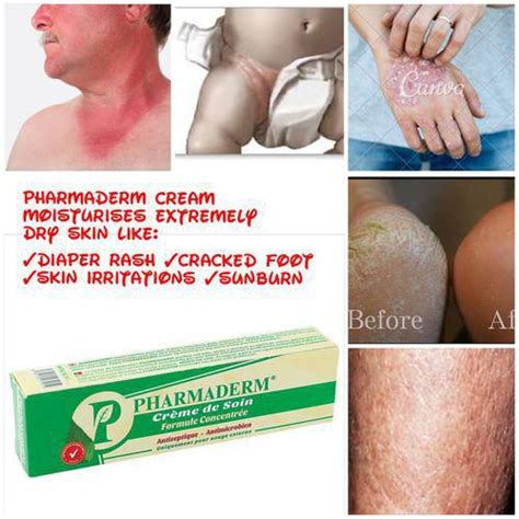 Pharmaderm Dry Skin Diaper Rash Cracked Foot Sun Burn Itchy Skin