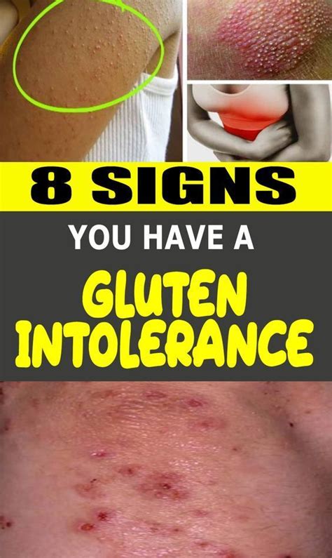 8 Signs You Have A Gluten Intolerance Lager Belajar Keperawatan