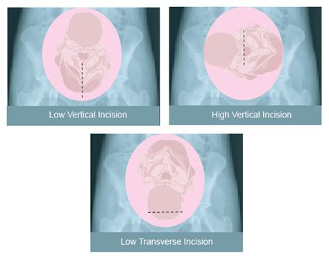 Low Transverse Uterine Incision Allows A Vaginal Birth After Cesarean