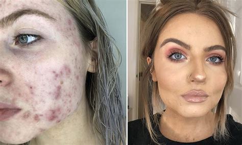 I Felt So Ugly A Woman 22 Worried Her Partner Would Leave Her Because Of Severe Acne