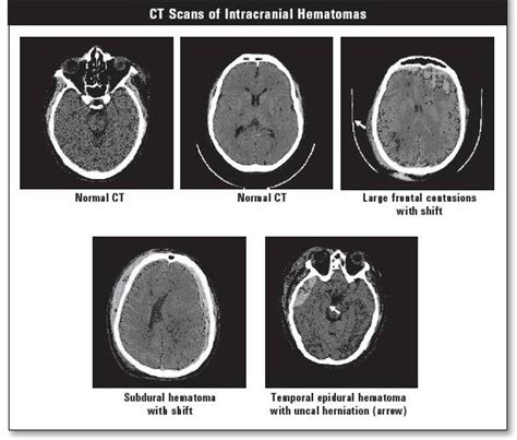 Hematoma Formation Comprehensive Guide On Types Symptoms Causes And