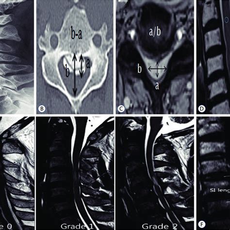 Measurements Of The Preoperative Radiological Factors In Cervical