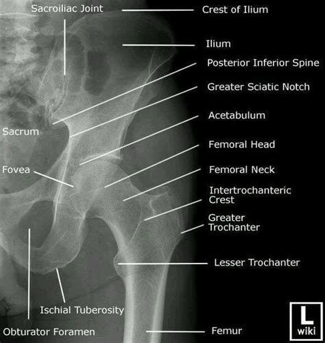 Pelvic Anatomy Xray Pelvis Anterior Posterior X Ray Anatomynote