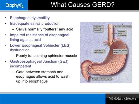 Overview Of Endoscopic Gastric Fundoplication