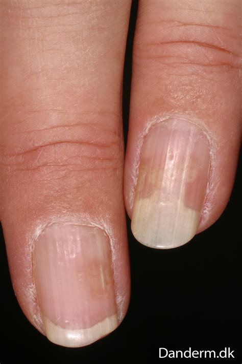 4 74 4 Psoriasis Of The Nails
