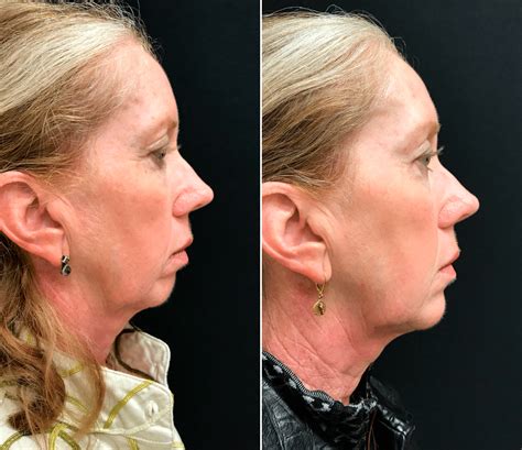 Nonsurgical Chin Augmentation With Voluma Filler Injections Before