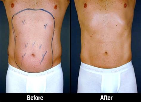 Abdominal Liposuction Before After Picture Of Male Patient Liposuction Abdomen Love Handles