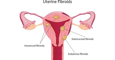 What To Expect If You Have Uterine Fibroids Preferred Vascular Group