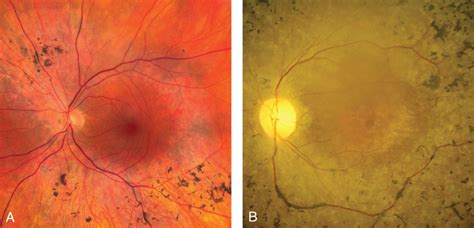 Hereditary Fundus Dystrophies Ento Key