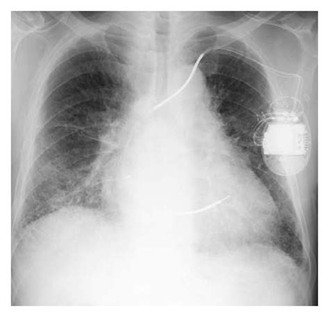 Symptoms typically include some combination of productive or dry cough, chest pain. Imaging Diagnosis of Interstitial Pneumonia with Emphysema (Combined Pulmonary Fibrosis and ...