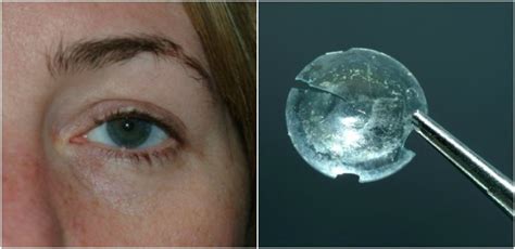 A Woman Had A Contact Lens Stuck In Her Eye For 28 Years And Did Not Notice At All