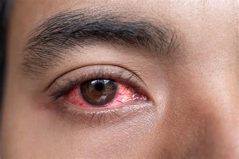 Red Eyes Problem Red Eye Treatment In Kuala Lumpur Malaysia