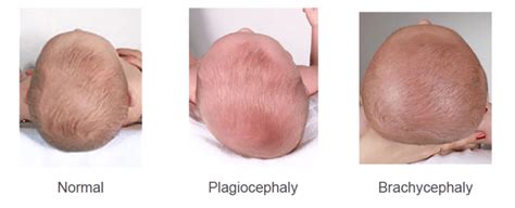 We did not find results for: What is Flat Head Syndrome? - Cherish Baby Care