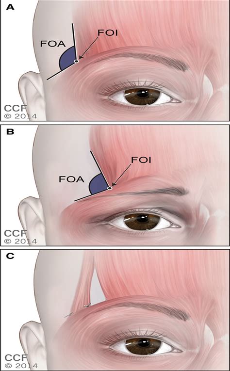 Small Incision Frontalis Muscle Transposition Flap For Later