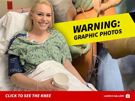 Lindsey Vonn Posts Disgusting Picture Of Knee During Lcl Surgery