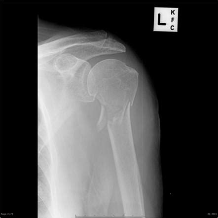 Shoulder Radiograph An Approach Radiology Reference Article