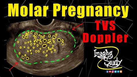 Molar Pregnancy Hydatidiform Mole TVS Doppler Ultrasound
