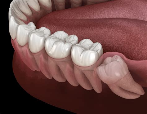 Wisdom Teeth Removal Gold Coast Emergency Dental
