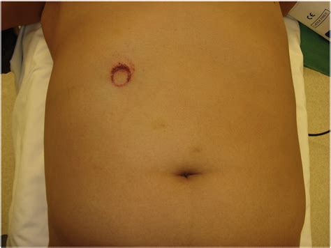 Laparoscopic Repair Of Traumatic Abdominal Wall Hernia From Handlebar