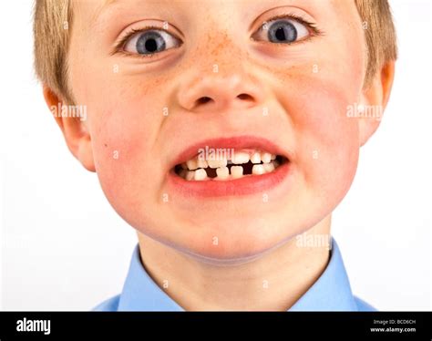 School Boy With Missing Teeth Stock Photo Alamy