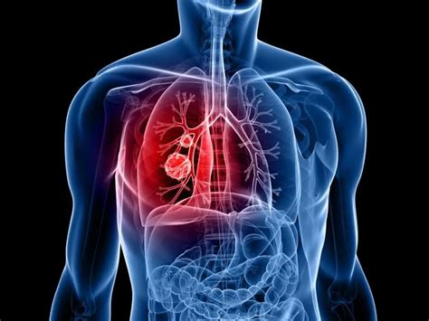 Lung Cancer Clinic And Clinical Group Diagnosis Symptoms Causes And