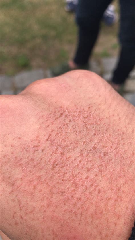 Skin Concerns After 3 Month Of Accutane My Arms And My Hand Looks