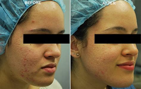 Large Pores Treatment Hellman Dermatology
