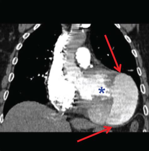 Chest Computed Angiotomography A B Large Pericardial Effusion Red