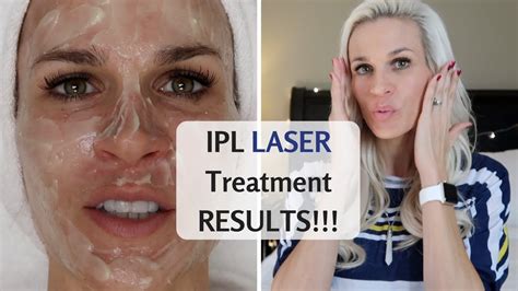Ipl Face Treatment Before After Doctor Heck