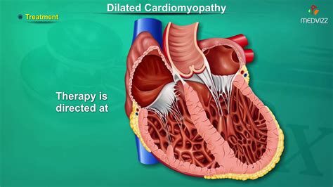 Dilated Cardiomyopathy Dcm Causes Signs And Symptoms