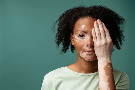 Vitiligo Causes Symptoms And Treatments Ace Mind