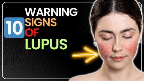 Warning Signs Of Lupus Youtube