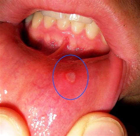 Canker Sore Pictures