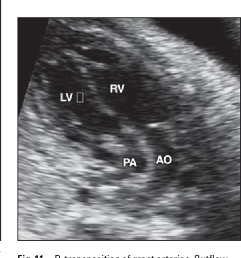 Figure 1 From Ultrasound Of Fetal Cardiac Anomalies Semantic Scholar